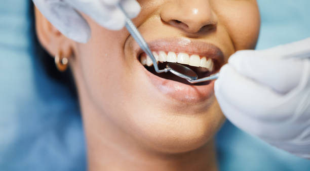 Best Emergency Wisdom Teeth Removal in Channelview, TX